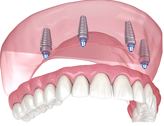 All-on-X Implants